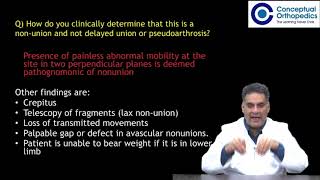 Theory  Nonunion by Dr Apurv Mehra [upl. by Gnot]