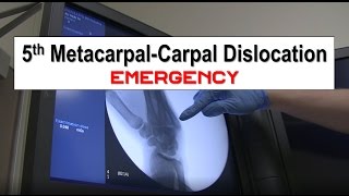 Fifth Metacarpal Dislocation and Reduction Emergency [upl. by Liagaba]