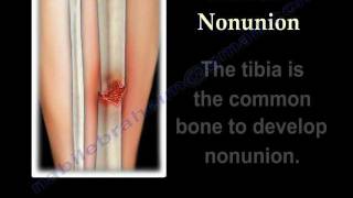 NONUNION OF FRACTURES CAUSES AND TREATMENT  Everything You Need To Know  Dr Nabil Ebraheim [upl. by Demha772]