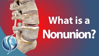 What is a Nonunion [upl. by Gimpel]