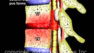 Spinal Infection video  Animation by Cal Shipley MD Trial Image Inc [upl. by Anaujd]