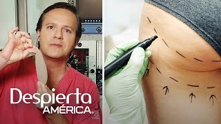 Mitos y realidades de los implantes de glúteo [upl. by Latrice194]