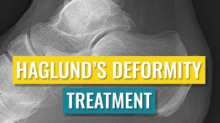 Haglunds Deformity Treatment [upl. by Irvin]