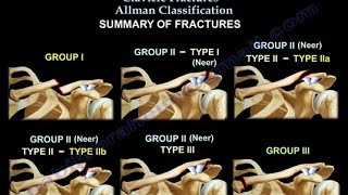 Clavicle Fractures Classification  Everything You Need To Know  Dr Nabil Ebraheim [upl. by Nahsaj]