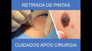 CUIDADOS APÓS CIRURGIA PARA REMOÇÃO DE PINTA [upl. by Silloh]