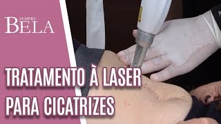 Tratamento à Laser Para Remoção de Cicatrizes  Sempre Bela 030219 [upl. by Ecyarg]