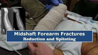 Reduction amp Splinting of Forearm FracturesQuick Version [upl. by Novelc134]