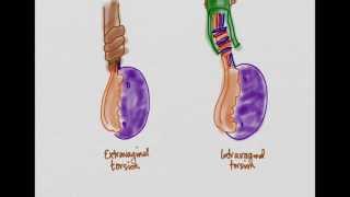 Testicular Torsion [upl. by Guss]