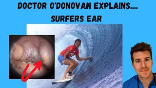 Explaining Surfers Ear aka Exostosis  With Dr ODonovan [upl. by Yhprum121]