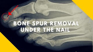 Bone Spur Under Big Toe Nail Subungual Exostosis [upl. by Haneekas]