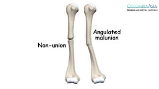 How are NonUnion amp Malunion of Fractures managed [upl. by Anelis245]