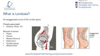 Lordosis Treatment A 3 Step Process [upl. by Casandra805]