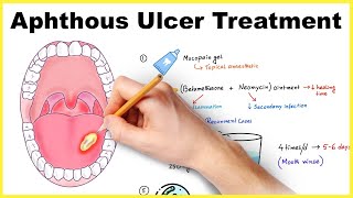 Aphthous ulcer stomatitis Canker sore treatment [upl. by Anyg125]