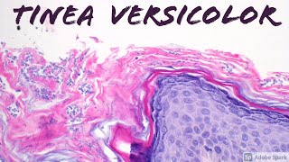 Tinea VersicolorPityriasis Versicolor Malassezia aka Pityrosporum Skin Infection Dermatology [upl. by Attlee308]