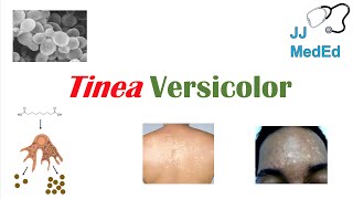 “Fungal Skin Infection of Many Colors” Tinea Versicolor  Pathogenesis Symptoms and Treatment [upl. by Annairoc]