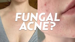 What is Fungal Acne We Discuss Skincare Treatments Causes amp More [upl. by Fidellas839]