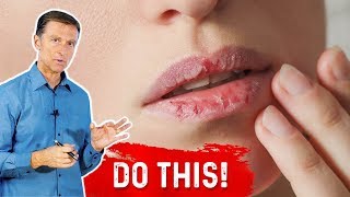 How To Fix Your Chapped Lips – DrBerg On Remedy For Chapped Lips [upl. by Mickey]